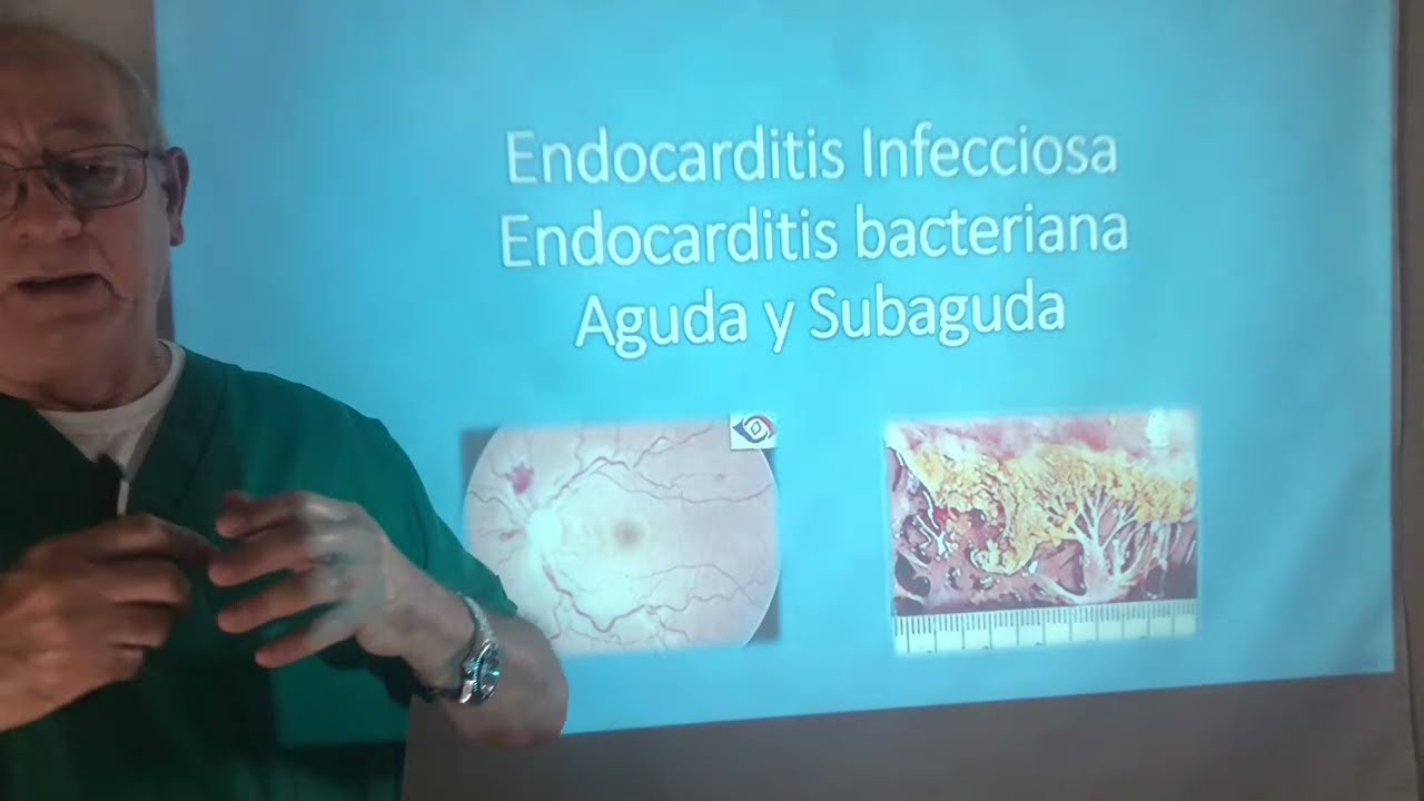 Endocarditis Bacteriana(Infecciosa). Soplo de Austin Flint. Recurso nemotécnico FROM JANE