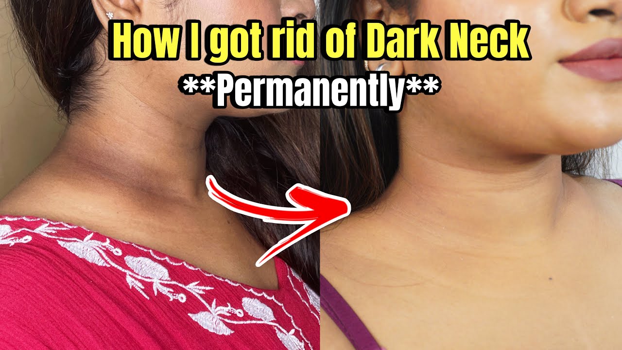 How to get rid of DARK NECK **PERMANENTLY**