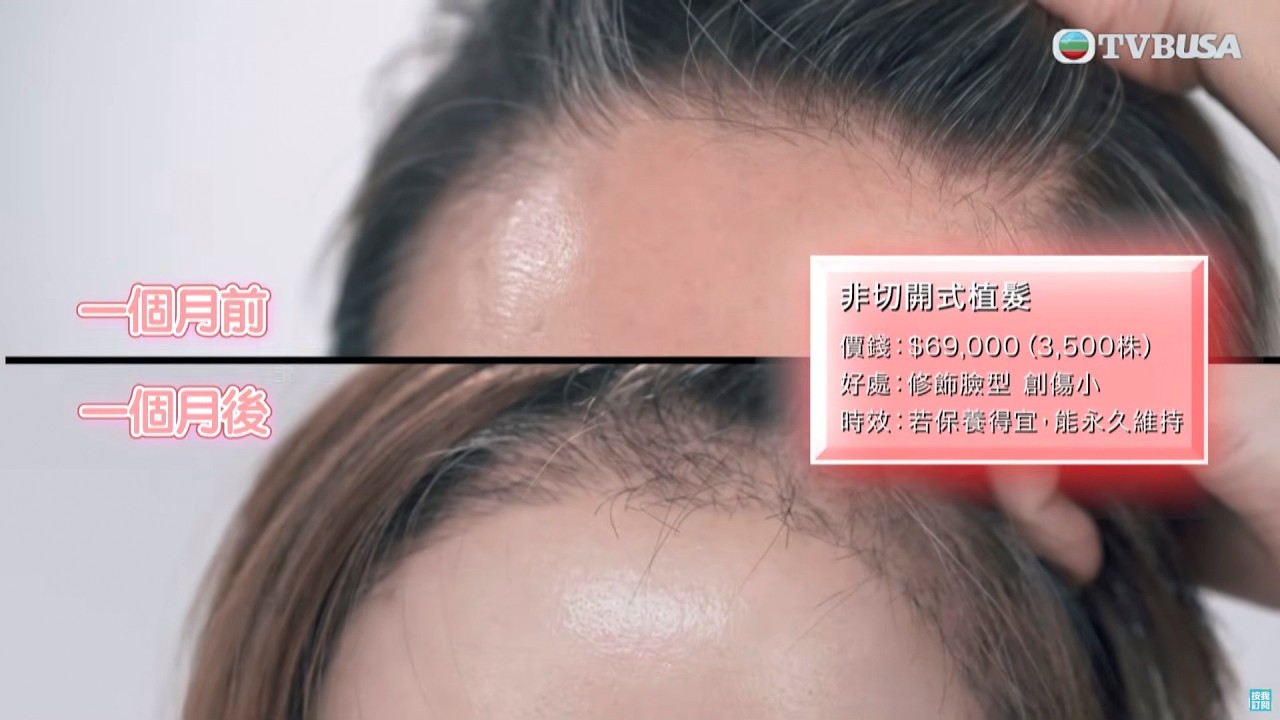 醫美直擊 首爾篇｜植髮過程令卓欣有少許怕？感覺到頭皮被拉扯或儀器運作的震動感。｜何依婷｜韓國｜醫美｜植髮過程｜