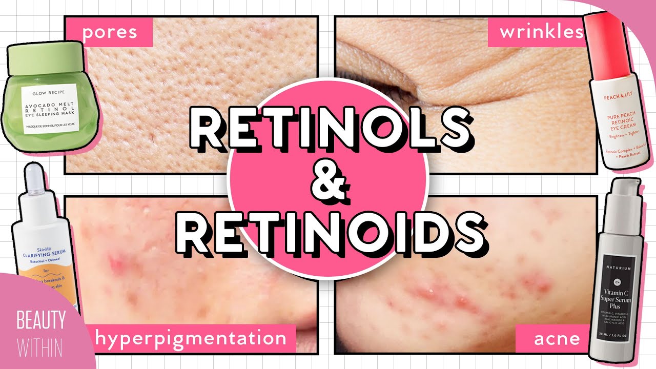 How to Use RETINOL for Acne, Hyperpigmentation, Large Pores, Fine Lines & More!