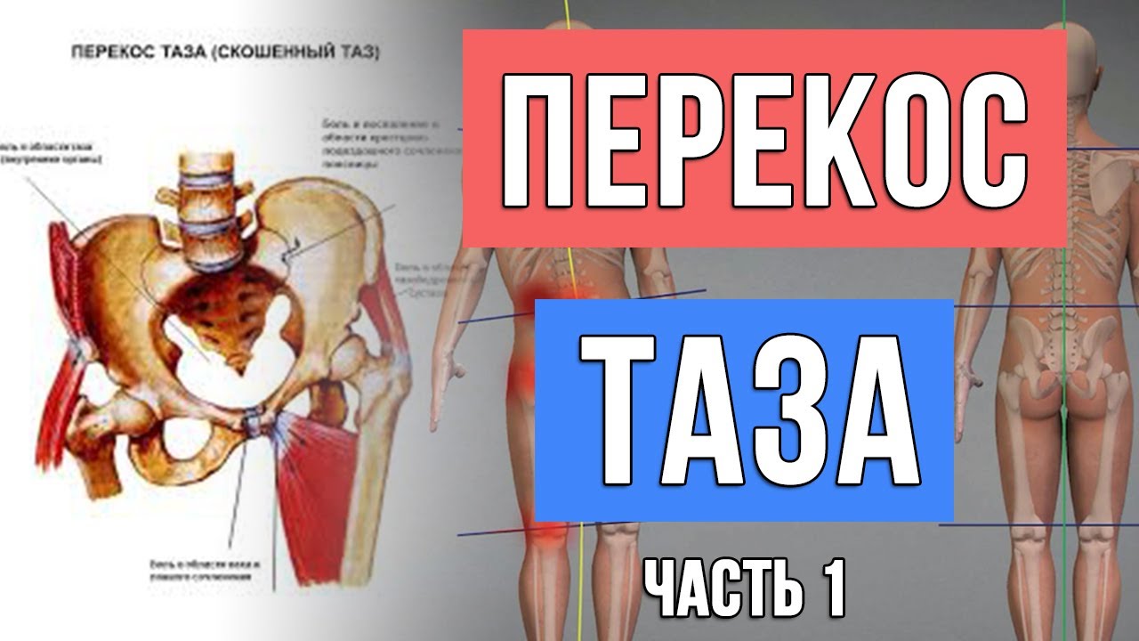 Перекос таза. Программа тренировок. Часть 1