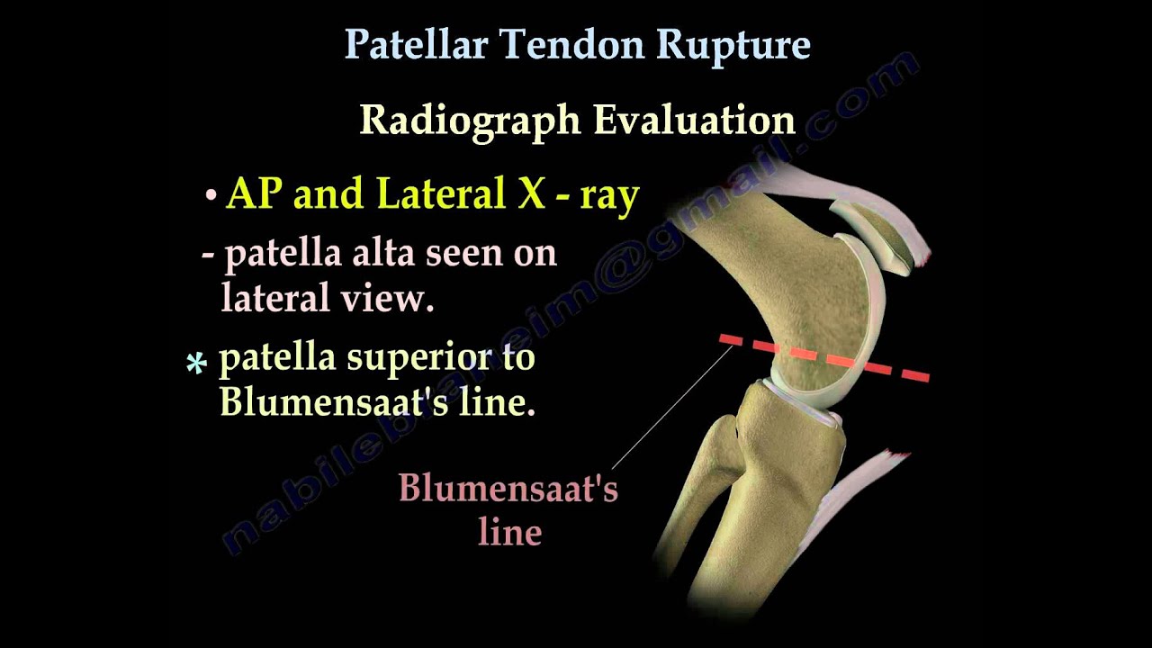 Patellar Tendon Rupture - Everything You Need To Know - Dr. Nabil Ebraheim