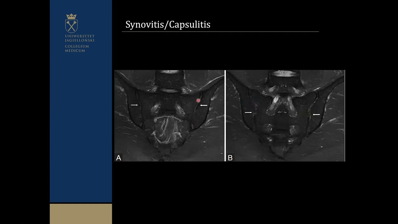 W. Wojciechowski - Spektrum zmian spondyloartropatii osiowej w metodach diagnostyki obrazowej