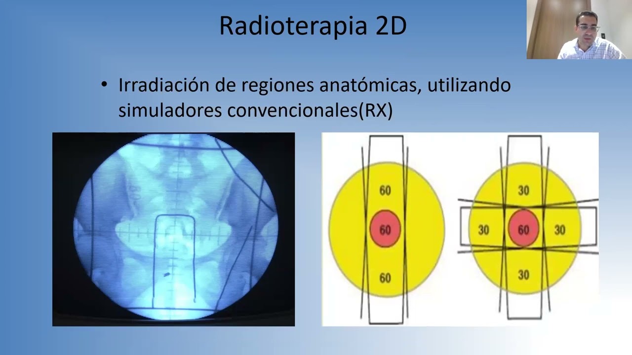 Seminario 365.  Principios de radioterapia en el tratamiento del cancer.  Dr. Rafael Lengua