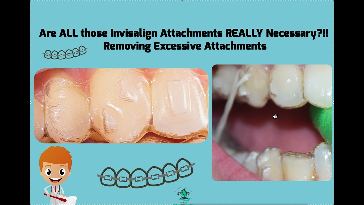 Are ALL of those Invisalign Attachments REALLY  Necessary?