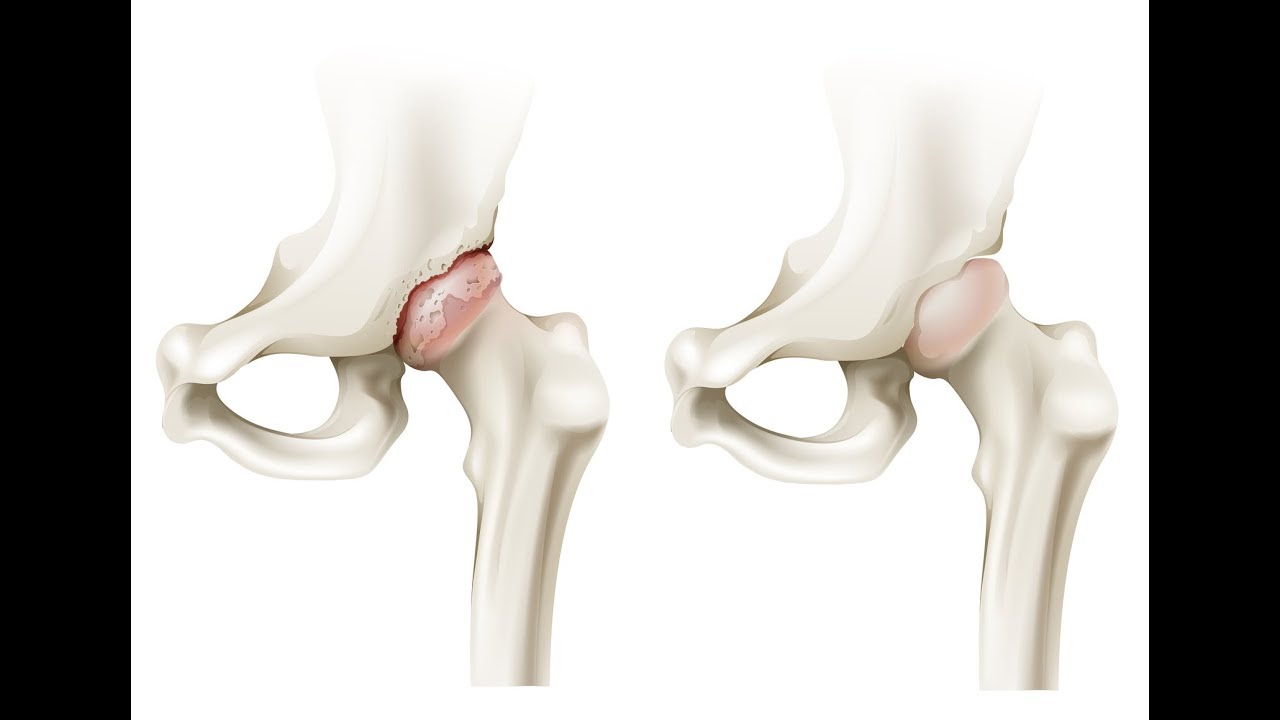 ¿Cuándo Debo Ponerme una Prótesis de Cadera? |  Cirujano Ortopédico Dr. Villanueva