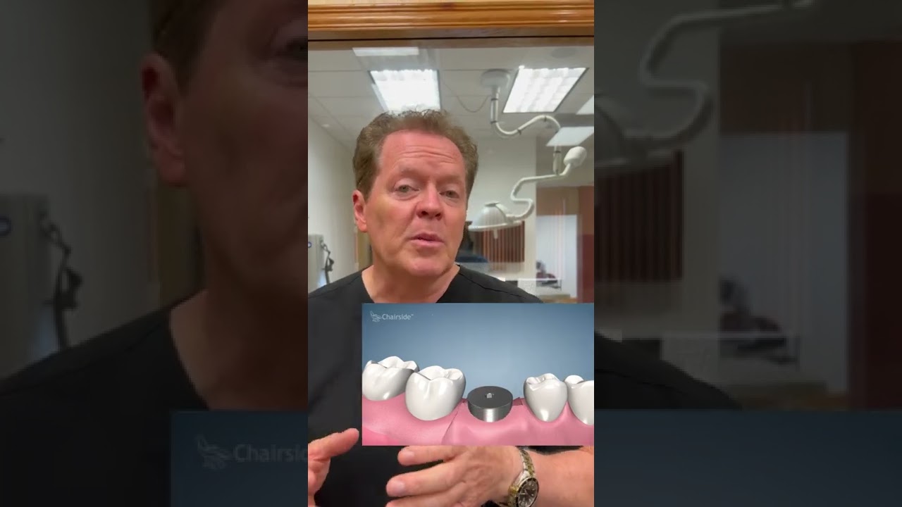 Smoking with Implants