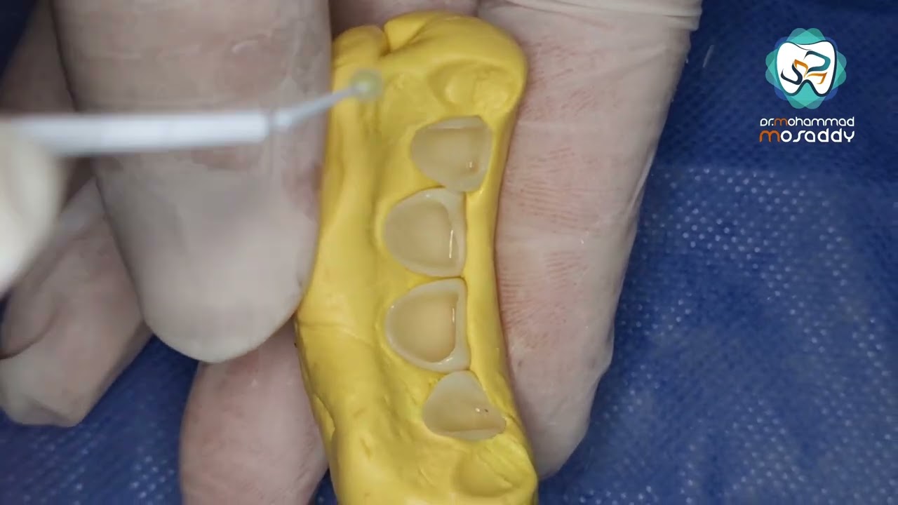 الصاق فينير أمامي .. veneer cemantation