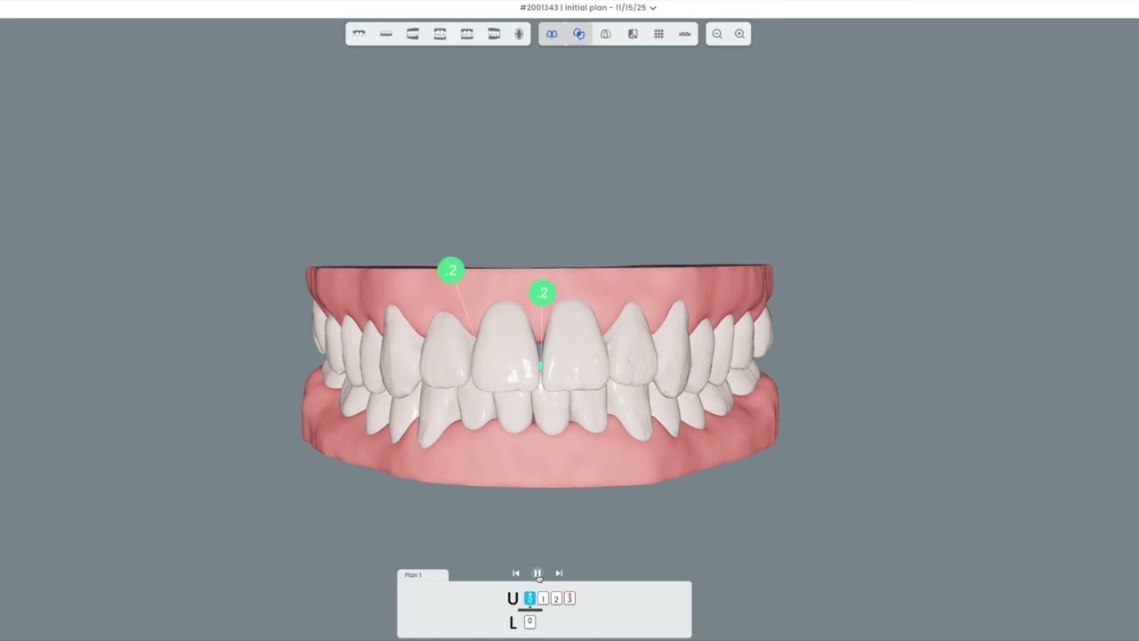 Social Six - Mild Max Anterior Spacing Case in uDesign Cloud