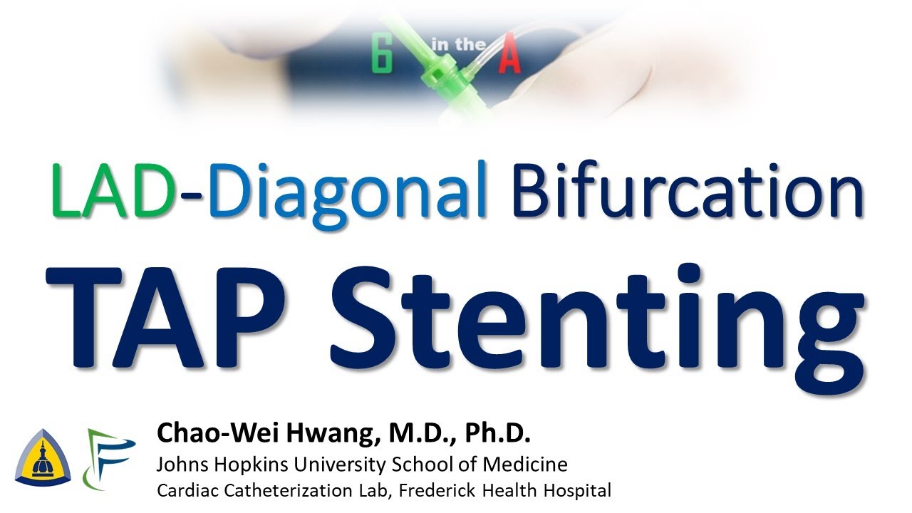 TAP Stenting of LAD-Diagonal Bifurcation