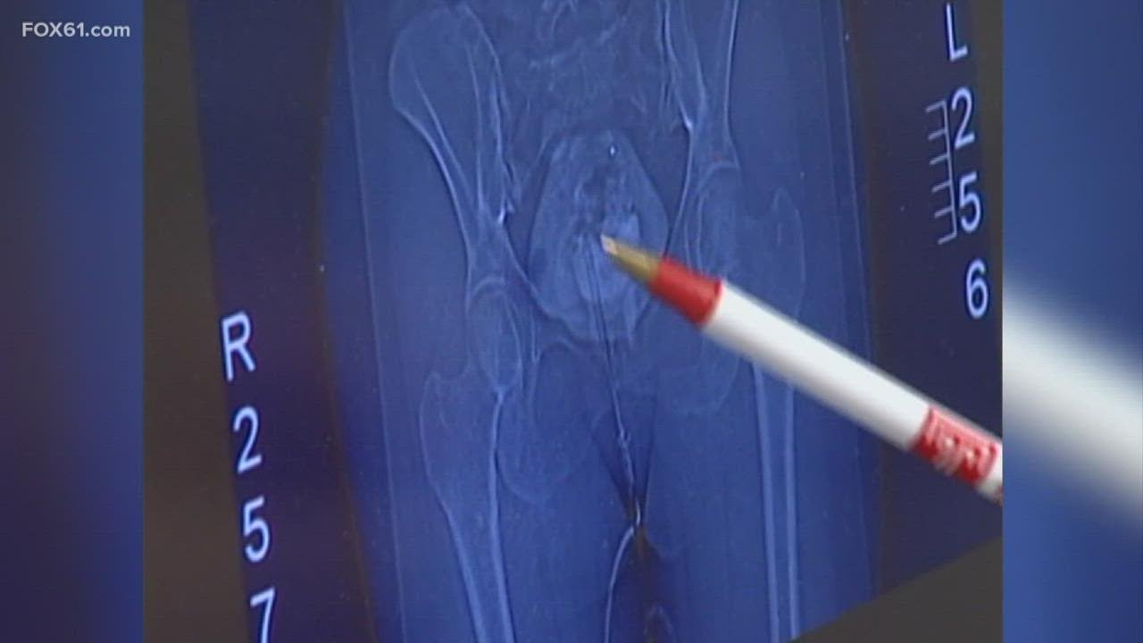 Black women being diagnosed with uterine fibroids at higher rates