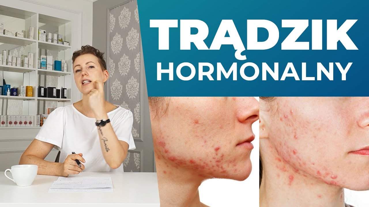 Co pomaga na trądzik hormonalny - bolesne wypryski na żuchwie i szyi? / Saga o trądziku cz. 5