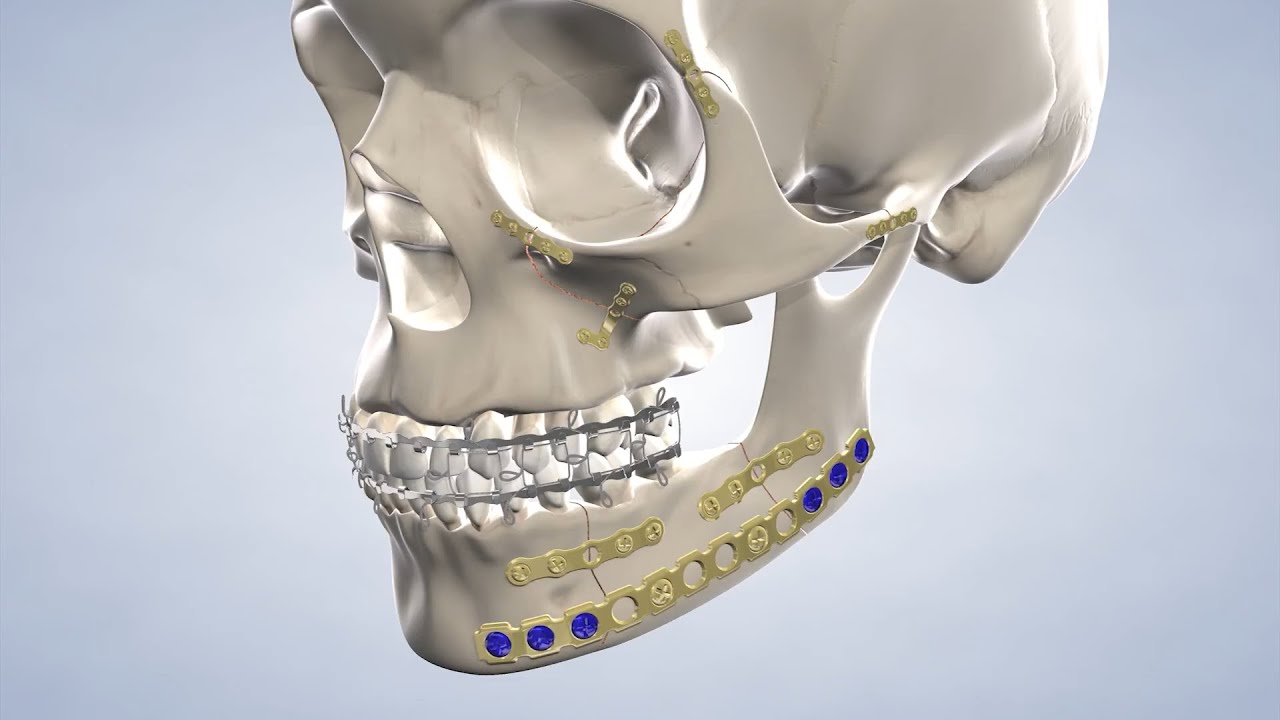 Facial Trauma in Waco TX | Brazos Oral & Facial Surgery