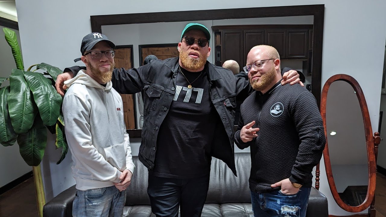 MARVIN KRONDON JONES III TALKS ALBINISM