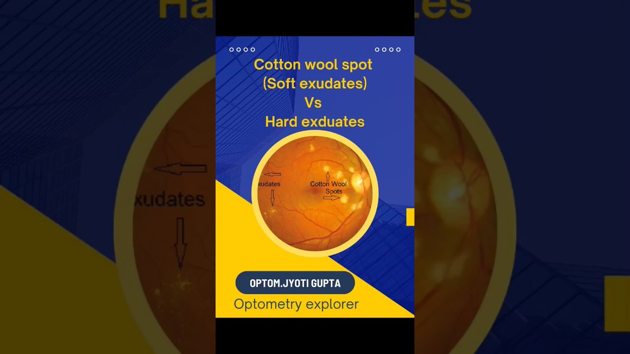 Cotton wool spot(soft exduates) Vs Hard exduates.
