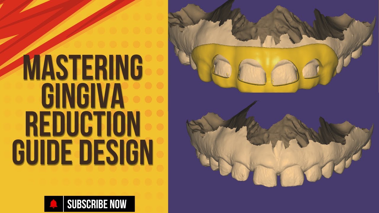 Mastering Gingiva Reduction Guide Design in #exocad  Step by Step Tutorial