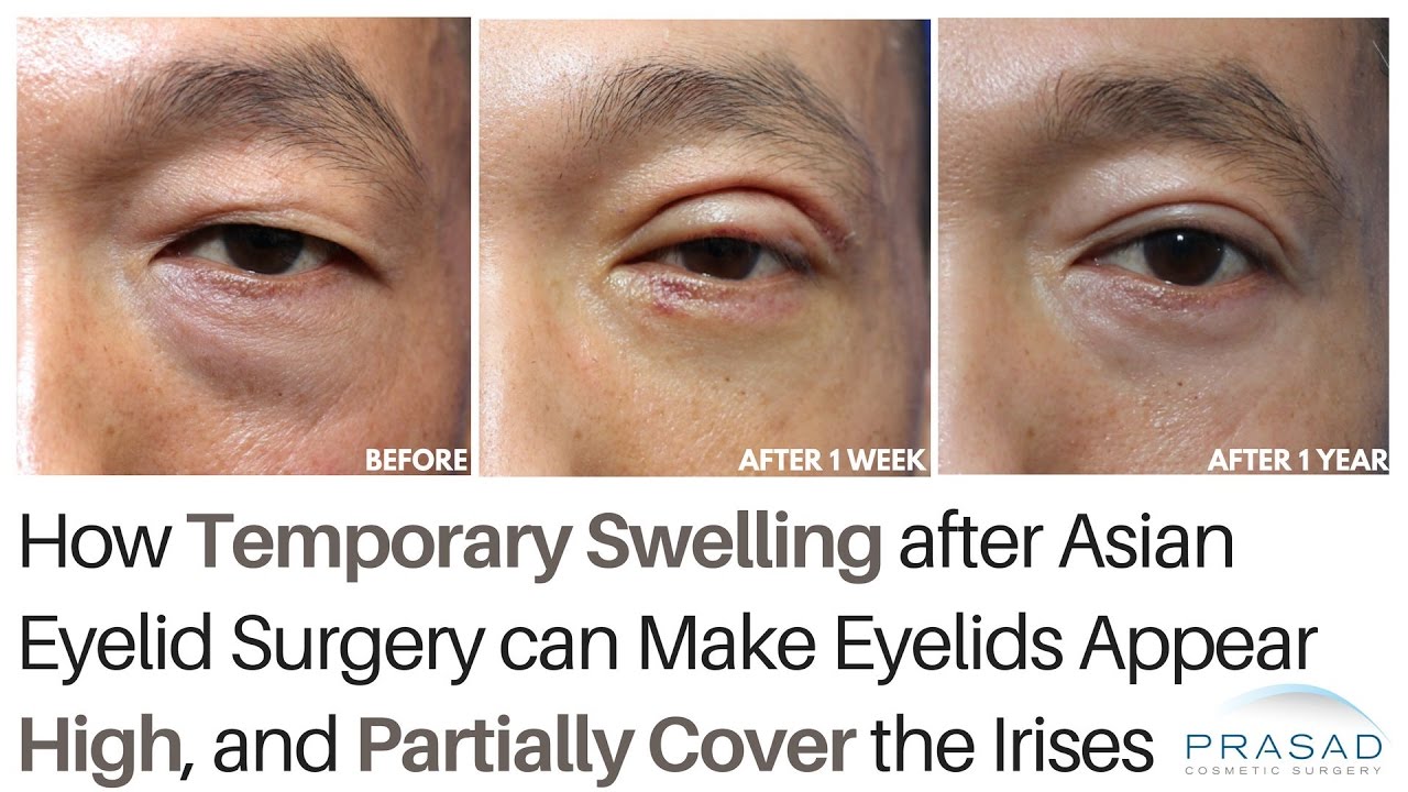 How Temporary Swelling from Asian Double Eyelid Surgery can Partially Cover Irises During Healing
