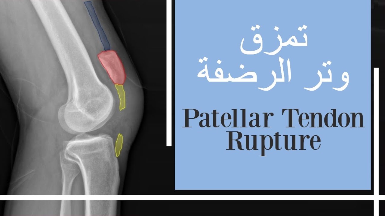 تمزق وتر الرضفة - قطع الوتر الرضفي - الم الركبة الامامي Patellar Tendon Rupture بالعربي