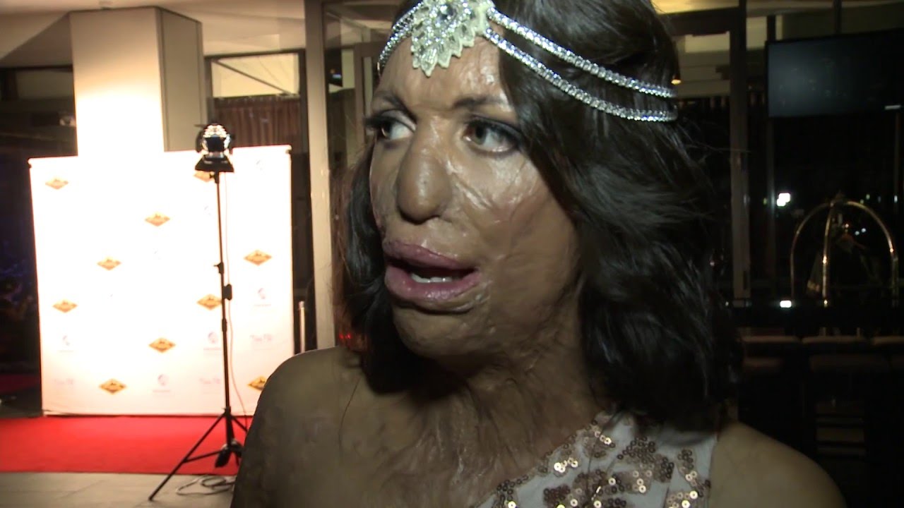 Partner with Turia Pitt and Interplast to change futures today