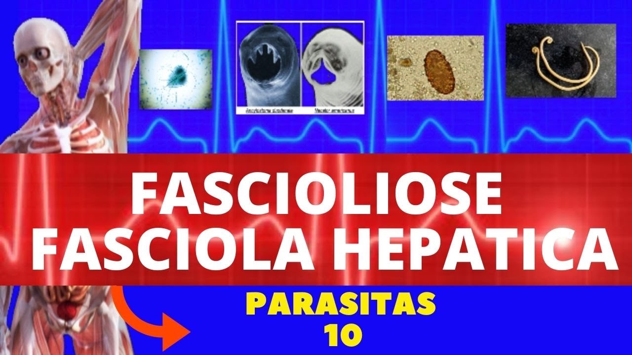 FASCIOLIOSE - FASCIOLA HEPATICA - PARASITOLOGIA| INFECTOLOGIA