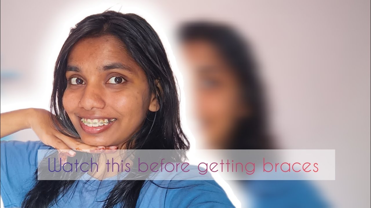 Watch this before getting braces| Thinking to get braces 