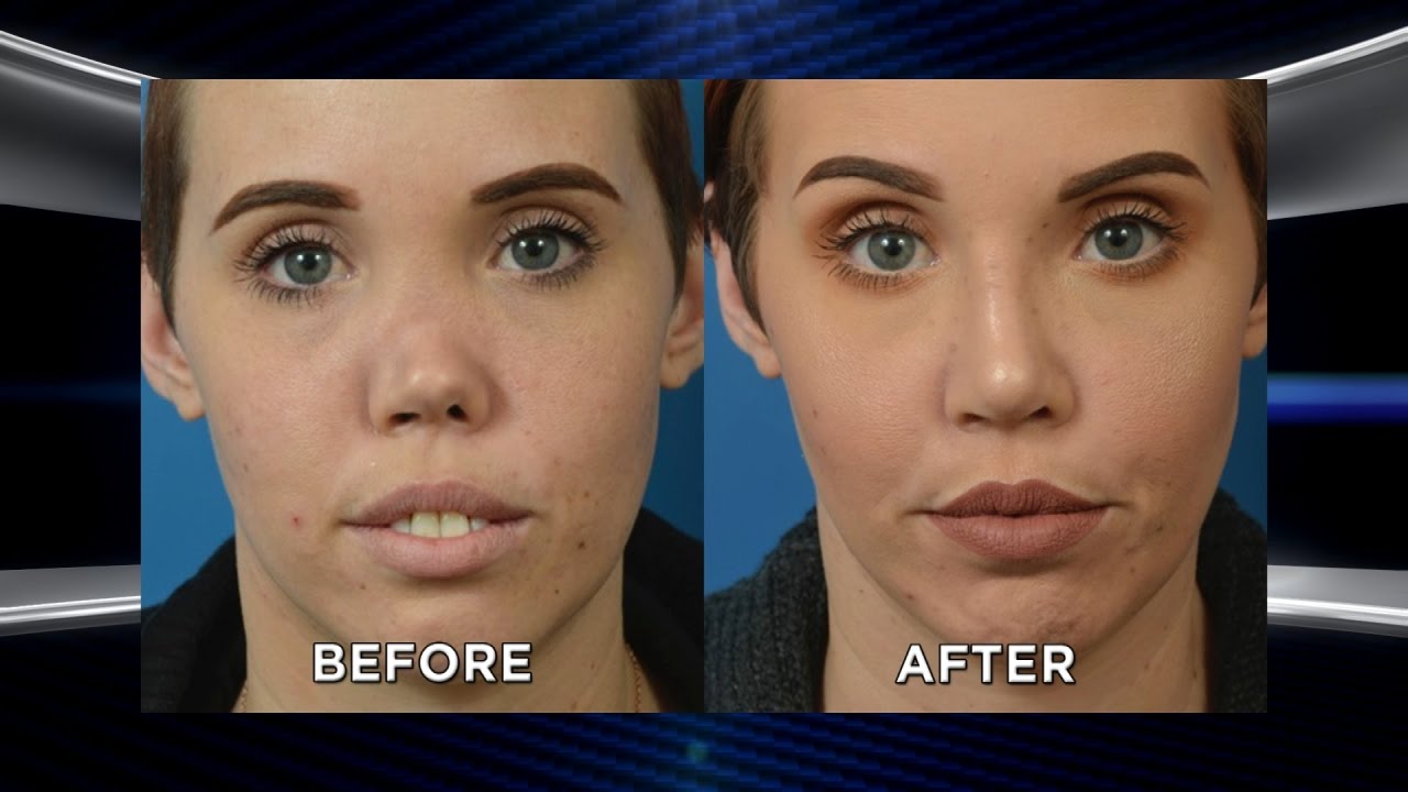 Dream Nose Makeover for Woman after Rare Disorder Collapsed Her Nose