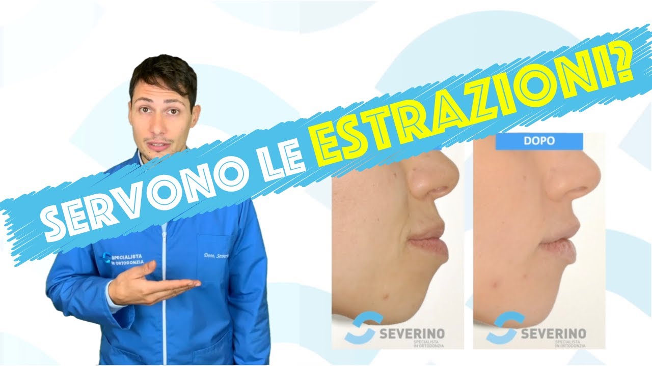 Estrazioni in ortodonzia - Vi racconto una storia. Migliorare l'estetica del tuo viso senza filler!