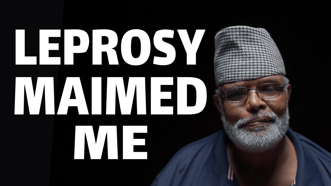 I Lost Fingers and Toes To Leprosy | Leprosy Survivor @TheUntold_Akathit