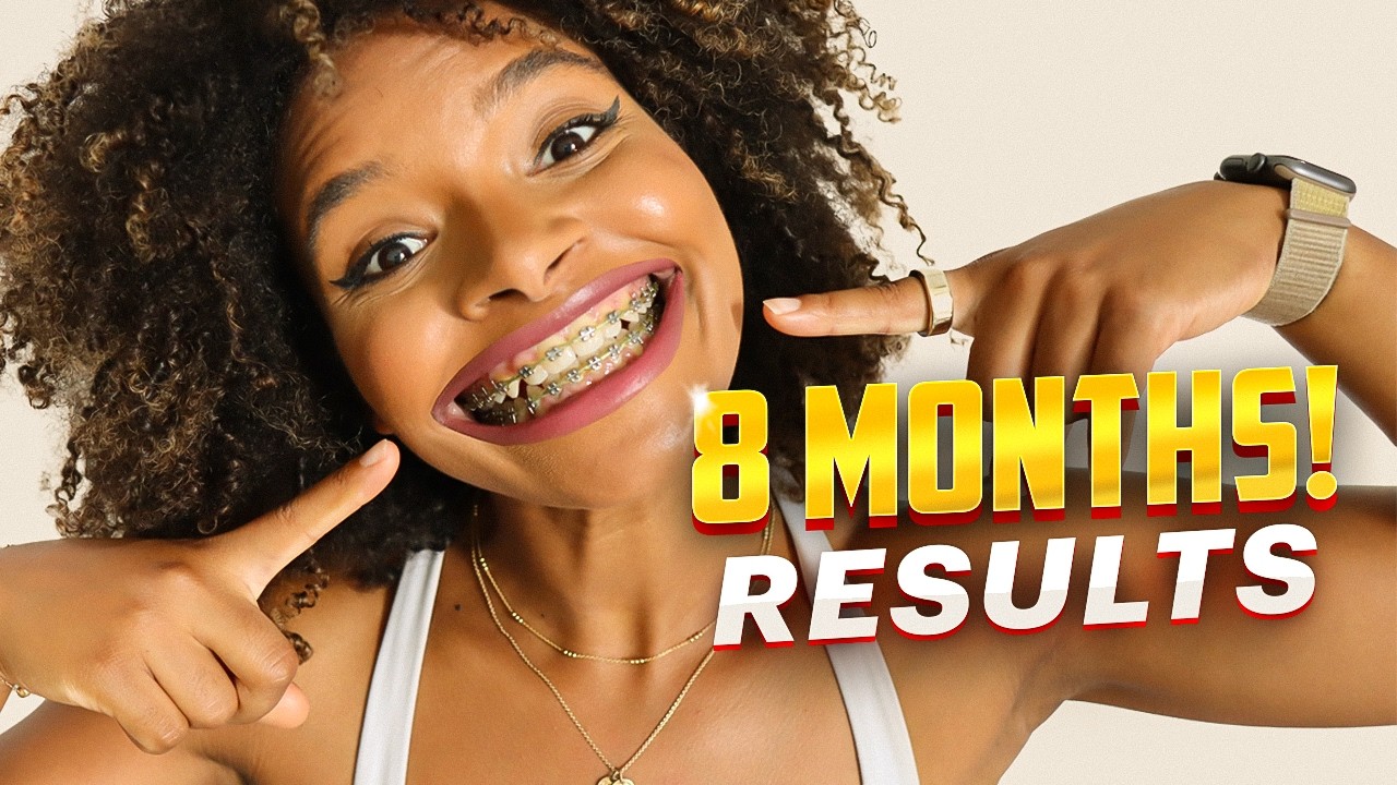 How New Elastics Changed My Progress after 8 Months with Braces