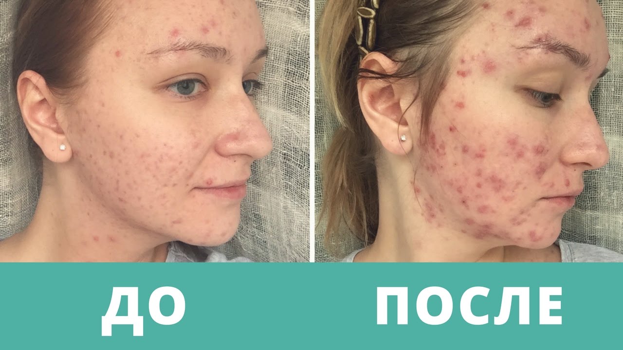 Дневник АКНЕкутана 11. СТРАШИЛКИ ПЕРВОГО МЕСЯЦА