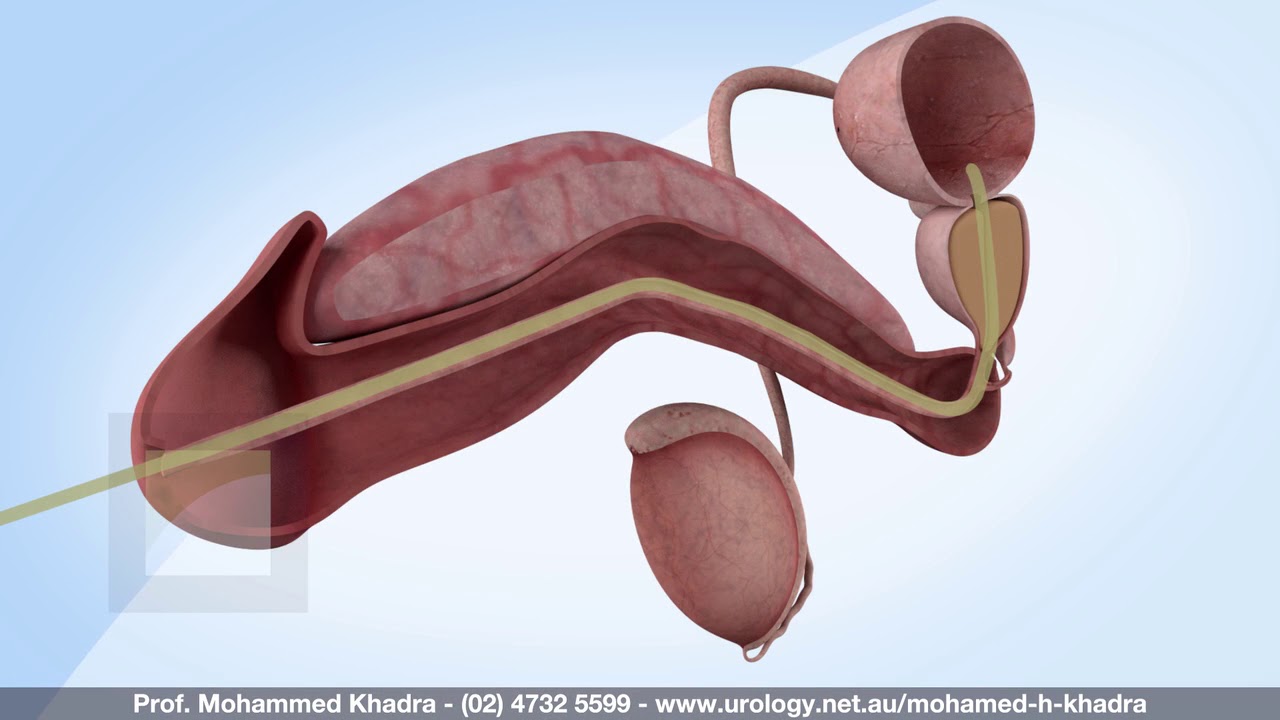 TURP - Trans-Urethral Resection of the Prostate - Professor Mohamed H Khadra