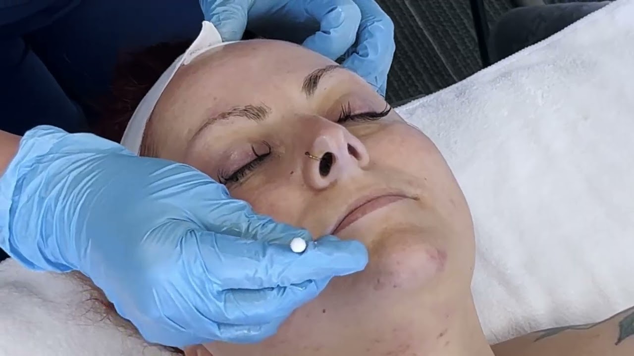 ADVANCED BASE2 Chemical Exfoliation Application