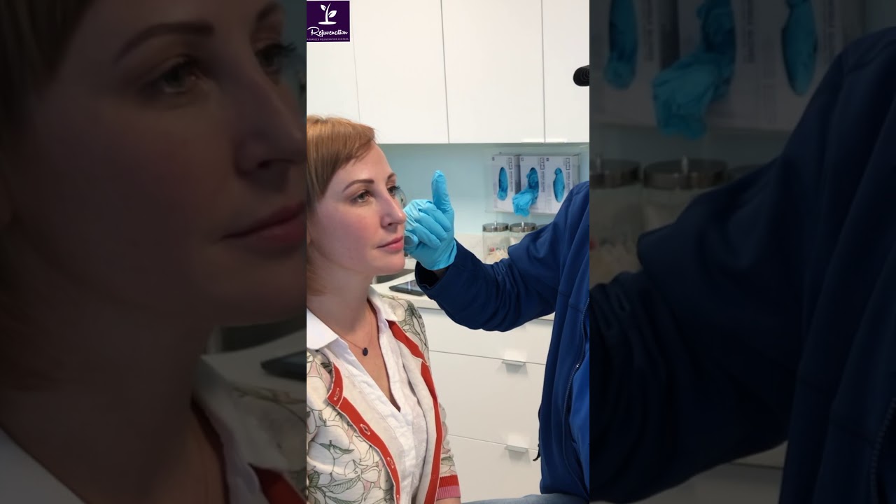Restylane Lyft Filler Treatment