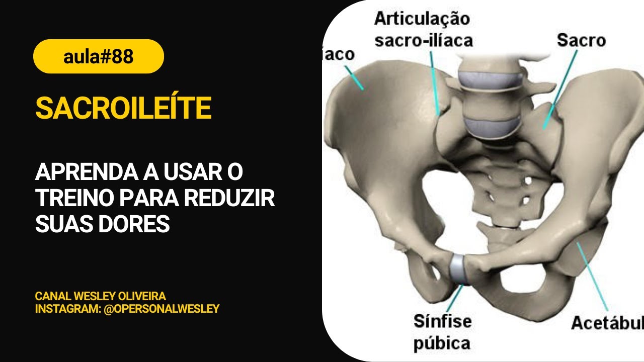SACROILEÍTE: use o alongamento e a musculação para aliviar suas dores #AULA88