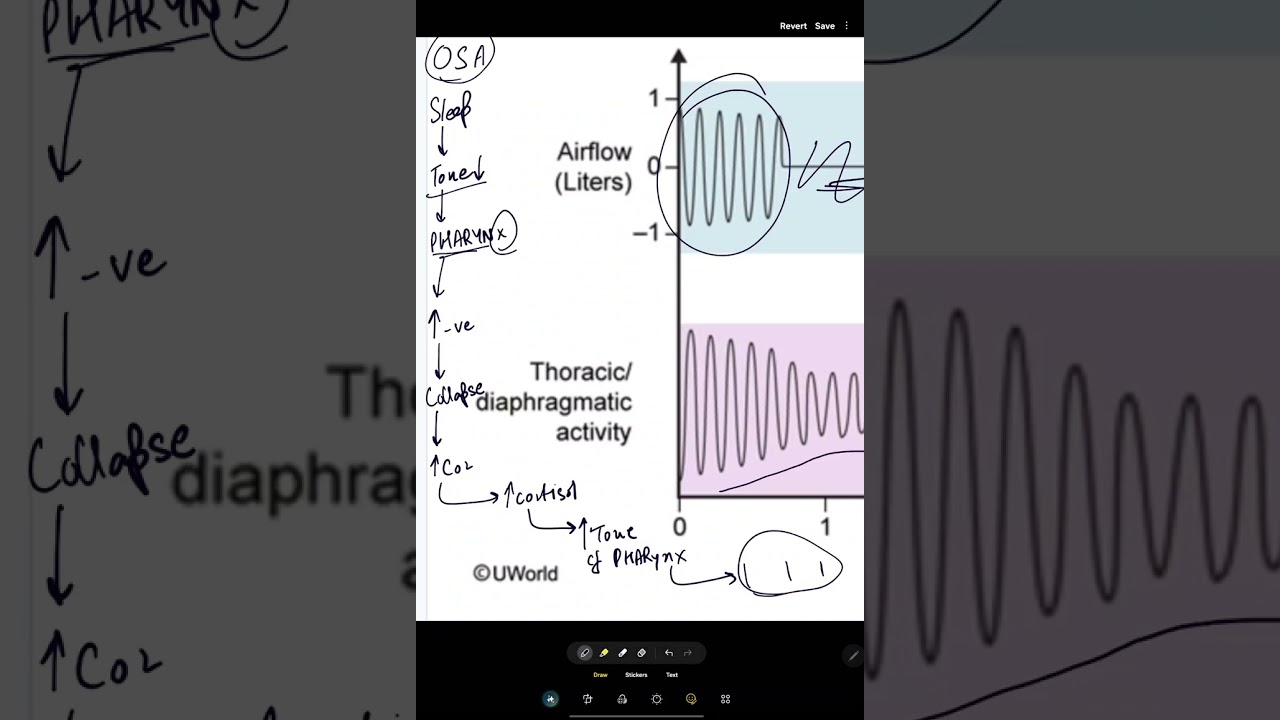 Obstructive sleep apnea 