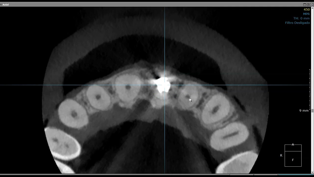 Dente com histórico de apicificação