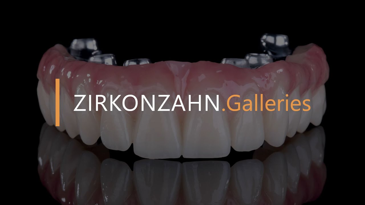 La Bartplatte – Rehabilitación estética sobre implantes palatinizados | Zirkonzahn.Galleries