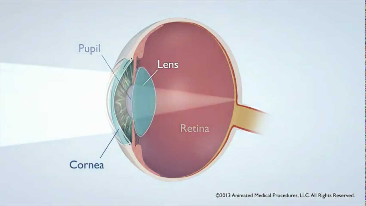 Laser Treatment for Cataracts with Astigmatism