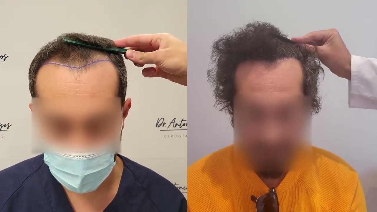 Injerto Capilar FUE - 2974 UFS - DR ANTONIO BURGOS