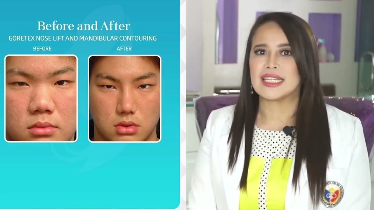 GORETEX RHINOPLASTY in the Philippines; best nose job, nose lift