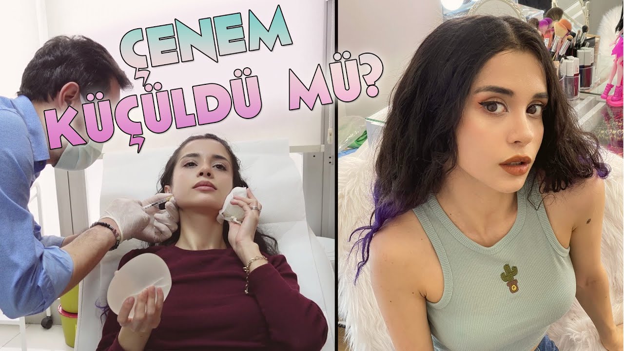 MASSETER BOTOKS YAPTIRDIM | O Dişler Artık Sıkılmayacak!