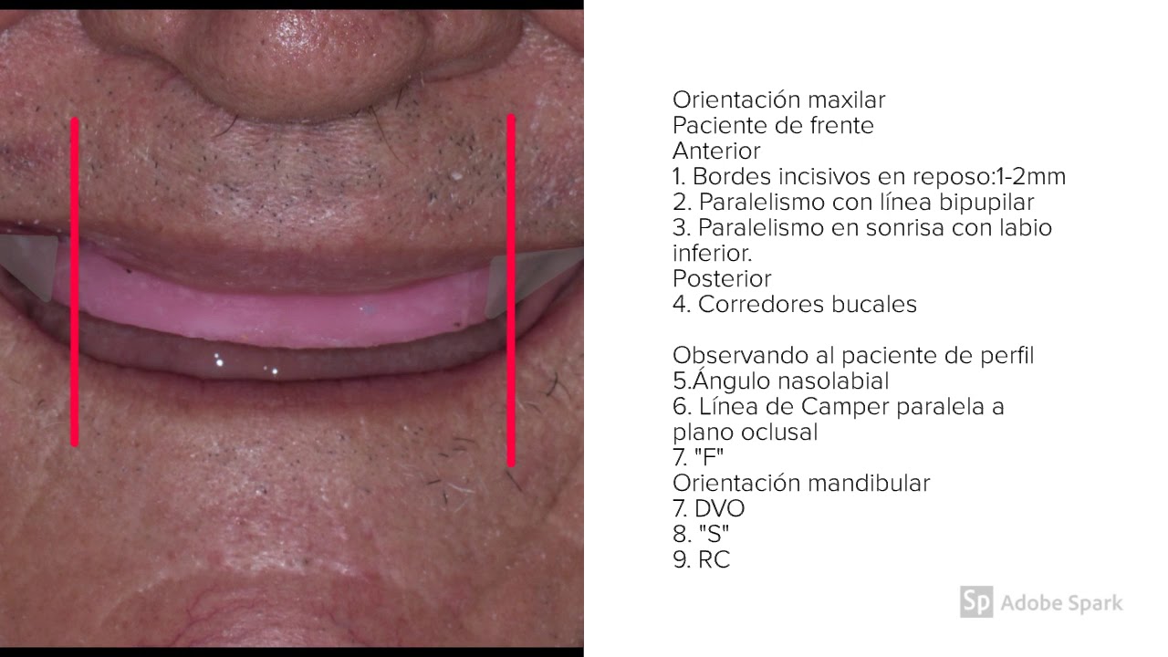 Prótesis totales Rodetes