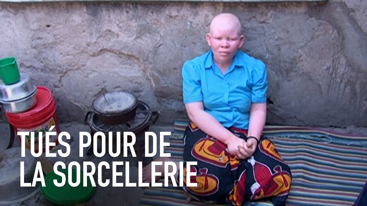 Meurtres d'albinos en Tanzanie