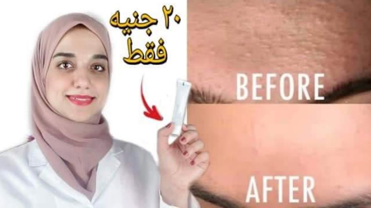 اسرع طريقة للتخلص من الحبوب تحت الجلد والحبوب البيضاء في ٣ ايام فقط..
