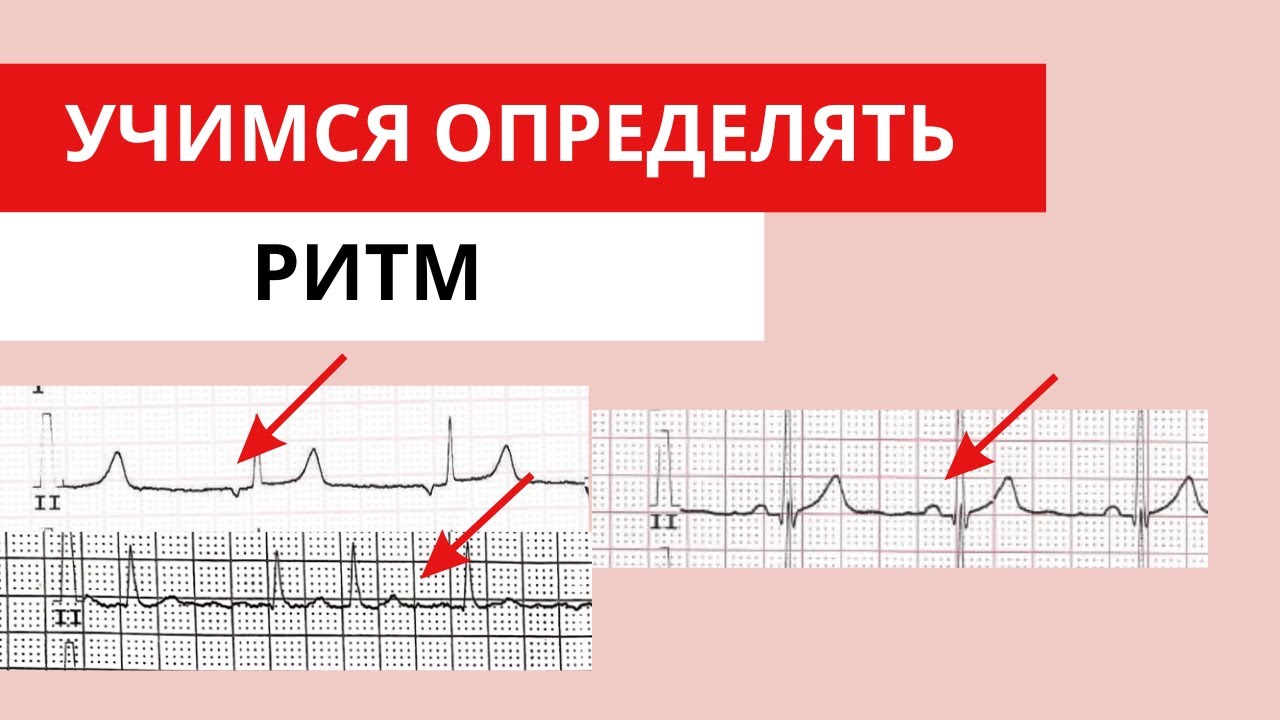 Учимся определять ритм. Пошаговая инструкция и ЭКГ примеры. Анализ ЭКГ.
