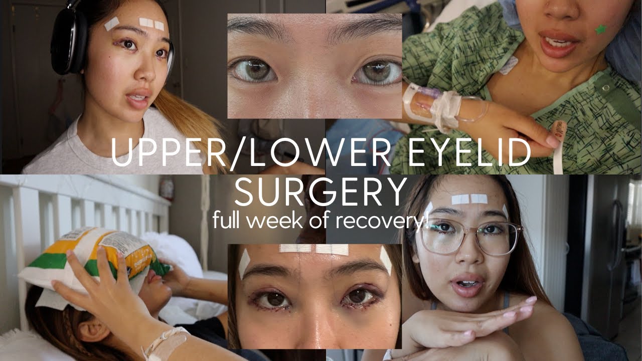 I GOT UPPER+LOWER  EYELID SURGERY (full surgery/recovery vlog)