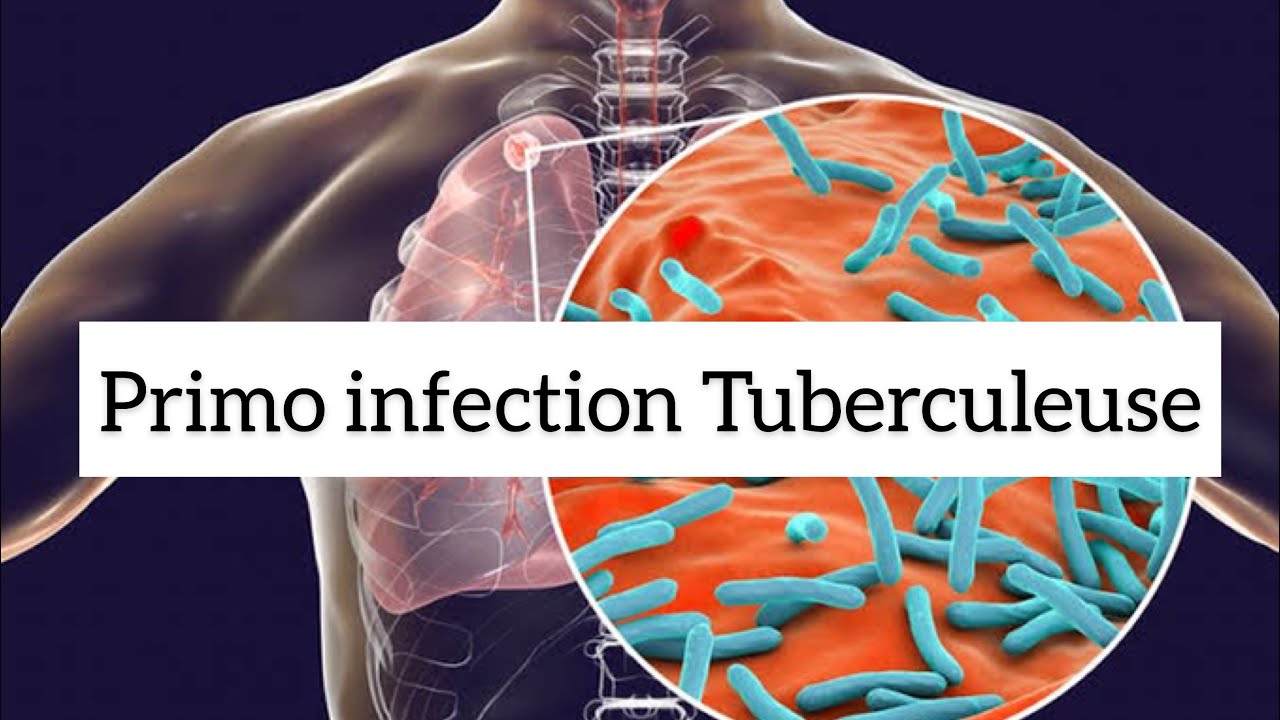 🔻Comprendre LA PRIMO INFECTION TUBERCULEUSE en 20 min !! 🔥🔥 | khadidja ferdj
