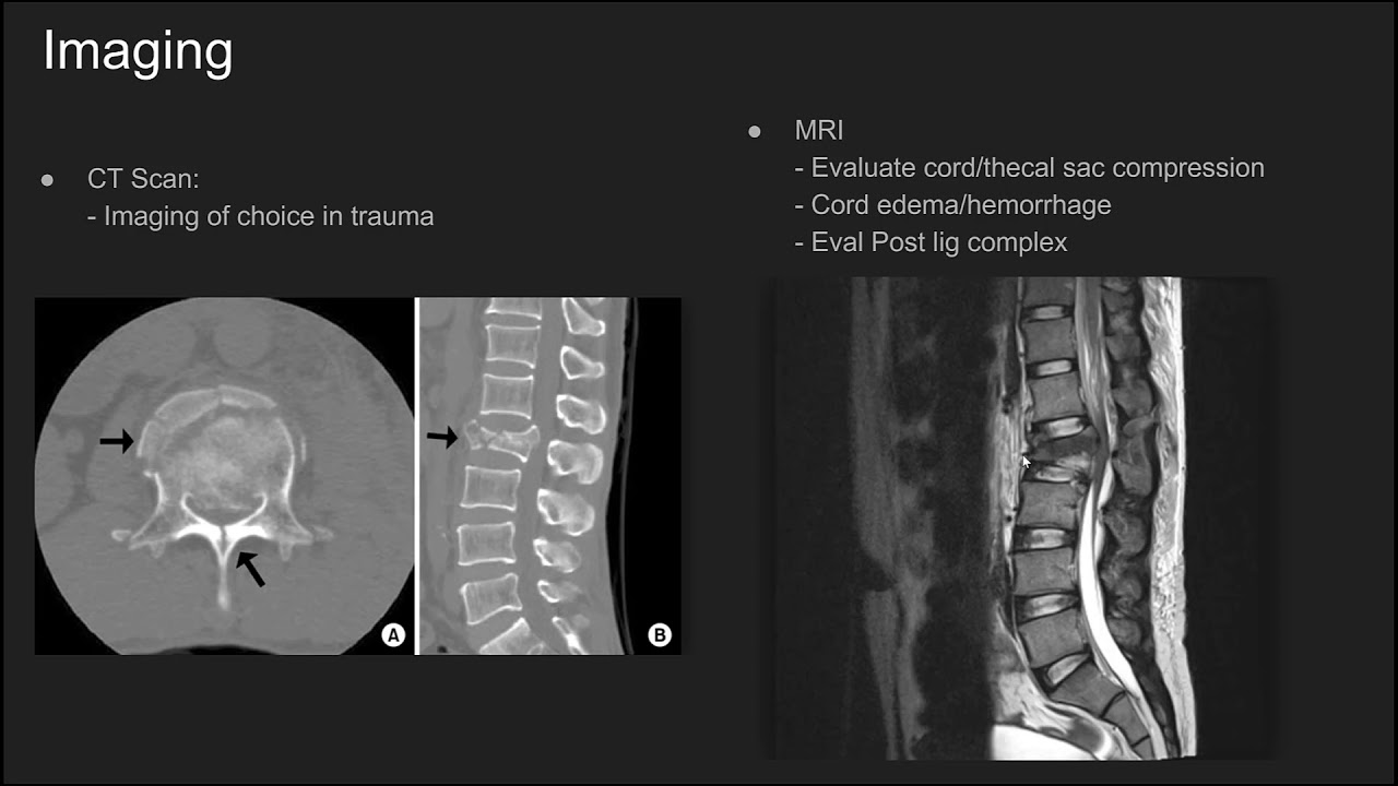Thoracolumbar Burst Fractures