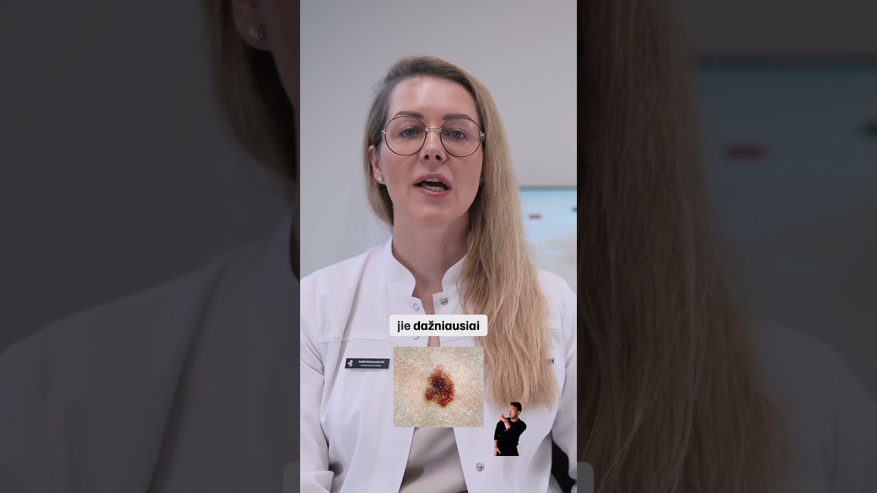 Turint tokį apgamą jį reikėtų stebėti atidžiau! 🟤🔍 #apgamai #apgamas #melanoma #apgamusalinimas