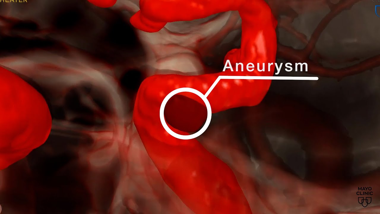 Mayo Clinic Minute - Who is at risk for a brain aneurysm?